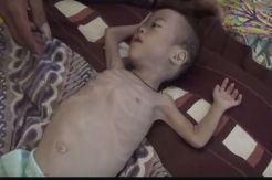 Al Gufron Balita Gizi Buruk di Tanggamus Luput dari Perhatian Pemerintah