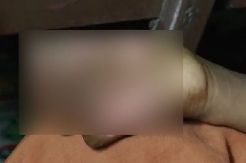 Ditinggal Ayah Melaut, Tangan Bocah 10 Tahun Dibakar Ibu Tiri