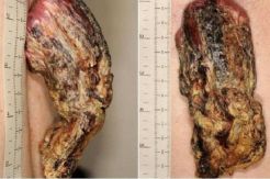Pria Inggris Memiliki Tanduk Naga 14 Cm di Punggung