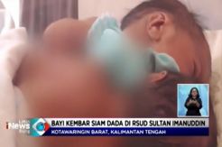 Tangani Bayi Kembar Siam RSUD SI Pangkalan Bun Koordinasi dengan RS dr Soetomo