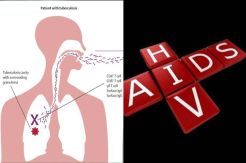 Mengapa Pasien TB Harus Tes HIV?