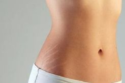 Stretch Mark Sulit Dihilangkan, tapi Bisa Disamarkan 5 Obat Rumahan Ini