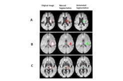 Kecerdasan Buatan Bantu Ahli Radiologi Diagnosis Stroke Lebih Akurat