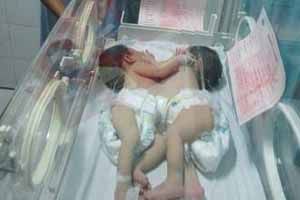 Bayi kembar siam Natalia...