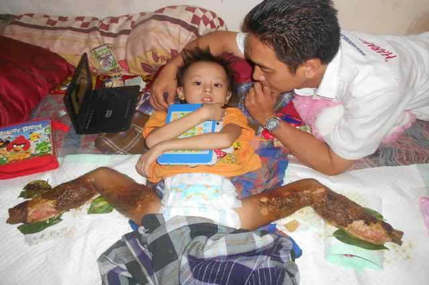 Balita kaki busuk akhirnya...