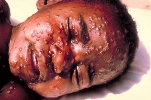 Waspada Virus Ebola,...