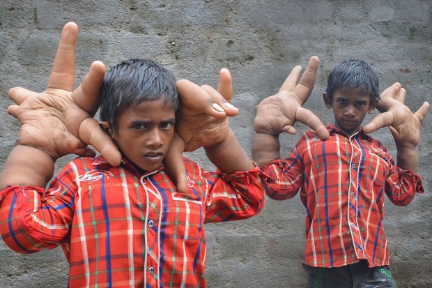 Bocah India Bertangan...