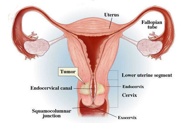 Pap Smear, Deteksi Dini...