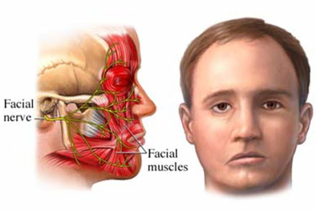 Apa itu Bells Palsy?