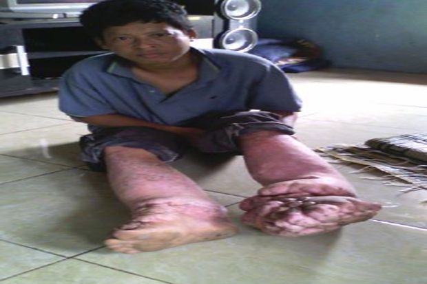 Menderita Penyakit Langka,...