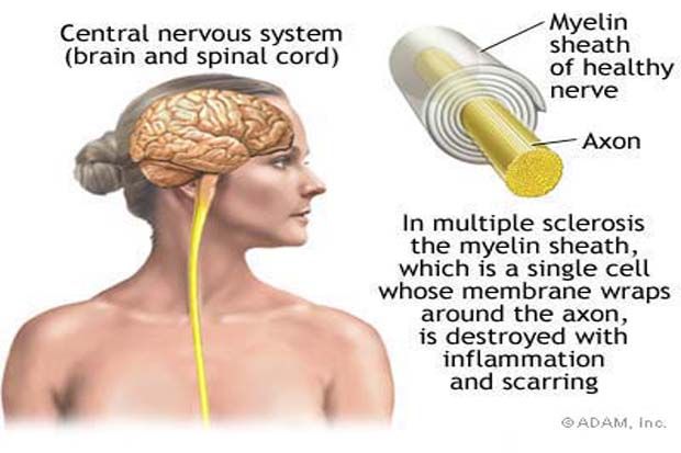 Pasien Multiple Sclerosis...