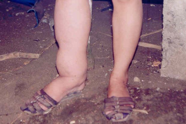 Penyakit Kaki Gajah...