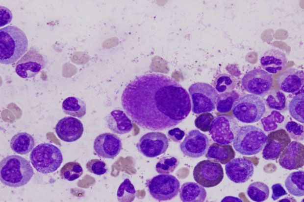 Chronic Myeloid Leukemia,...