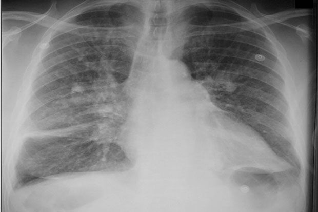 Pneumoconiosis Jadi...