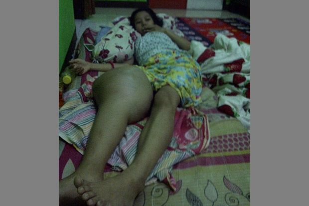 Derita Kanker Tulang,...