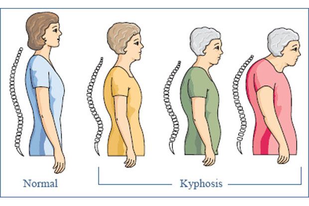 Bantu Cegah Osteoporosis...