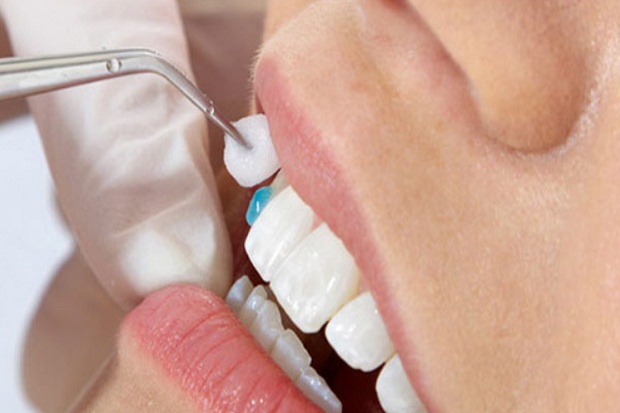 Teknologi Cantik Veneer...