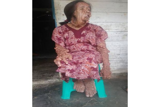 Tolong, Penderita Kanker...