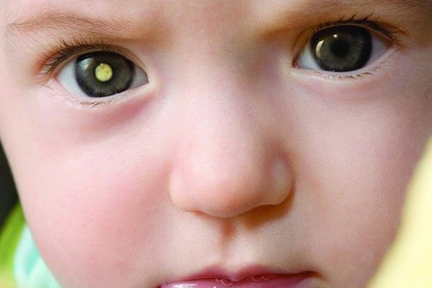 Waspada! Kanker Retinoblastoma...