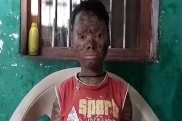 Sakit Langka, Manusia...