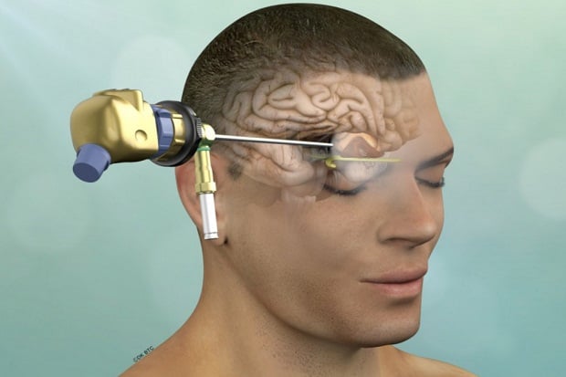Metode Operasi Tumor...