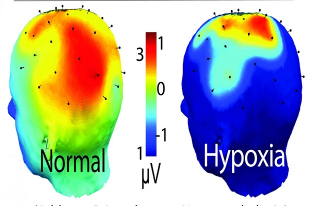 Waspadai Hypoxia, Penyakit...