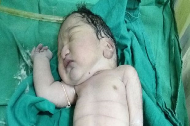 Bayi Putri Duyung Terlahir...