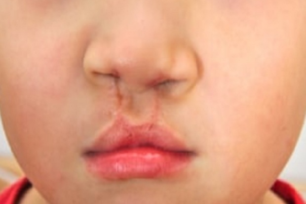 Jumlah Kasus Bibir Sumbing...