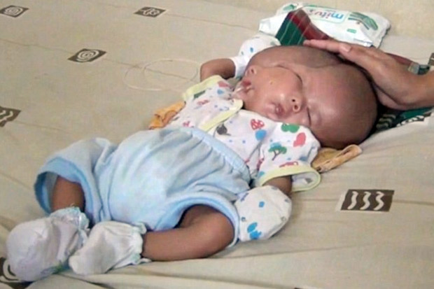 Kelahiran Bayi Dua Wajah...