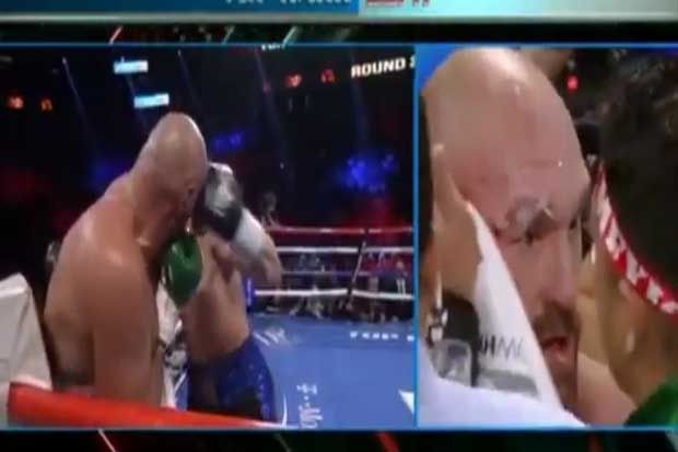 Luka Mata Kanan Tyson...