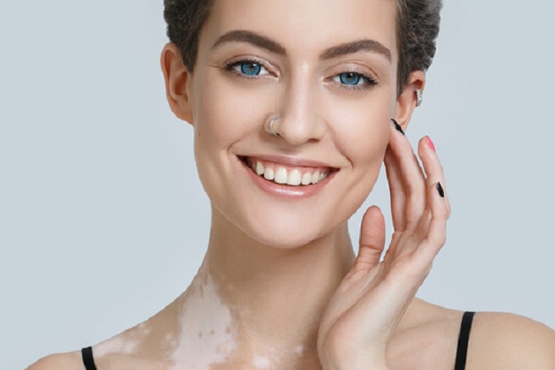 Penyakit Kulit Vitiligo...
