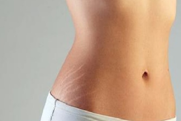 Stretch Mark Sulit Dihilangkan,...